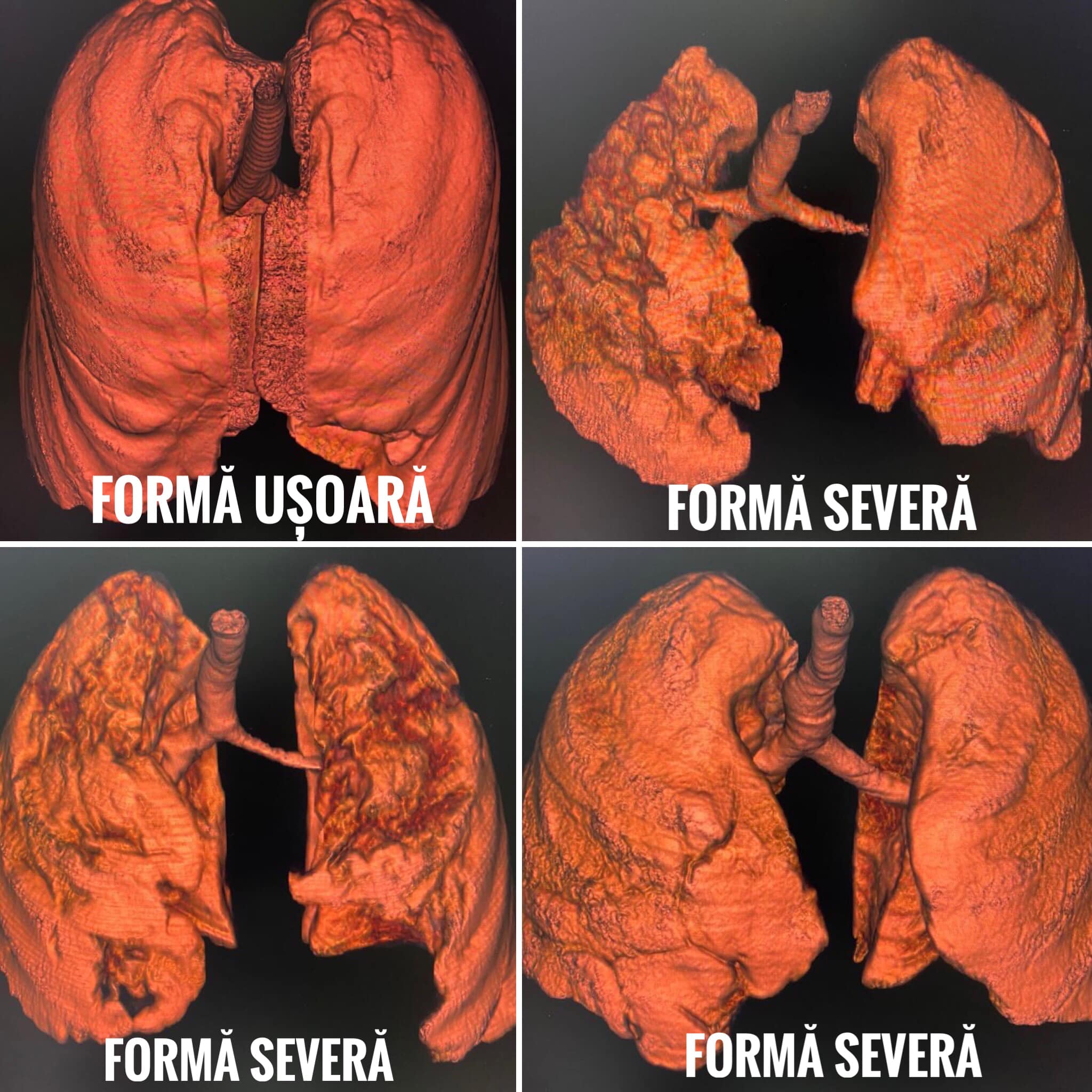 Cum arată plămânii unor pacienți nevaccinați bolnavi de COVID-19