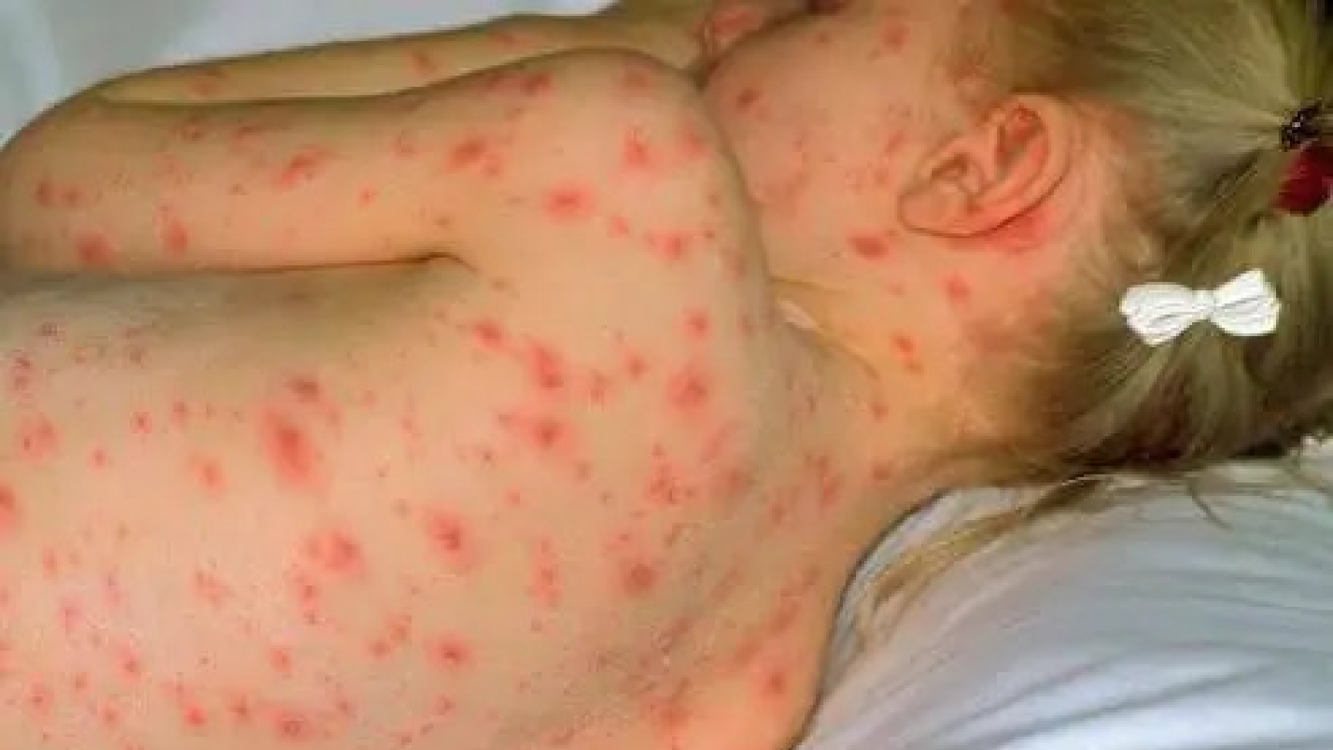 Un copil cu varicelă hemoragică, o boală rară, a fost internat la Spitalul din Timișoara