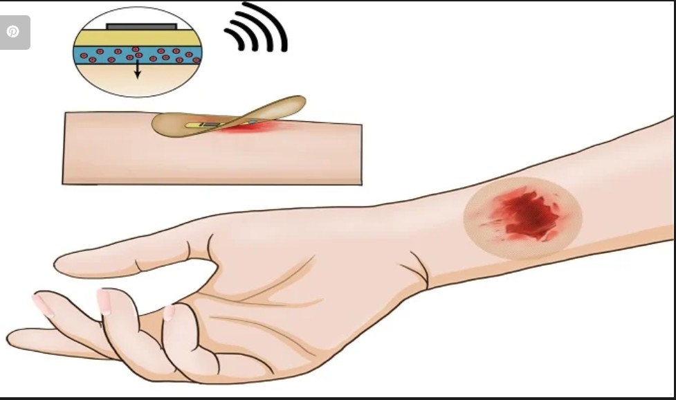 Pansament electronic care accelerează cicatrizarea rănilor