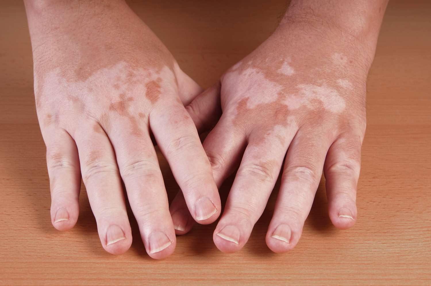 EMA a da undă verde unui prim tratament contra vitiligo