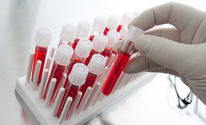 Greșeli care pot influența rezultatele analizelor de sânge, inclusiv diagnosticul