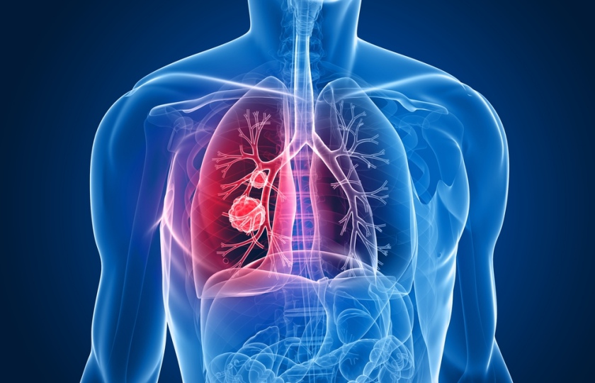 <strong>Tratament care reduce la jumătate riscul de deces în cancerul pulmonar</strong>