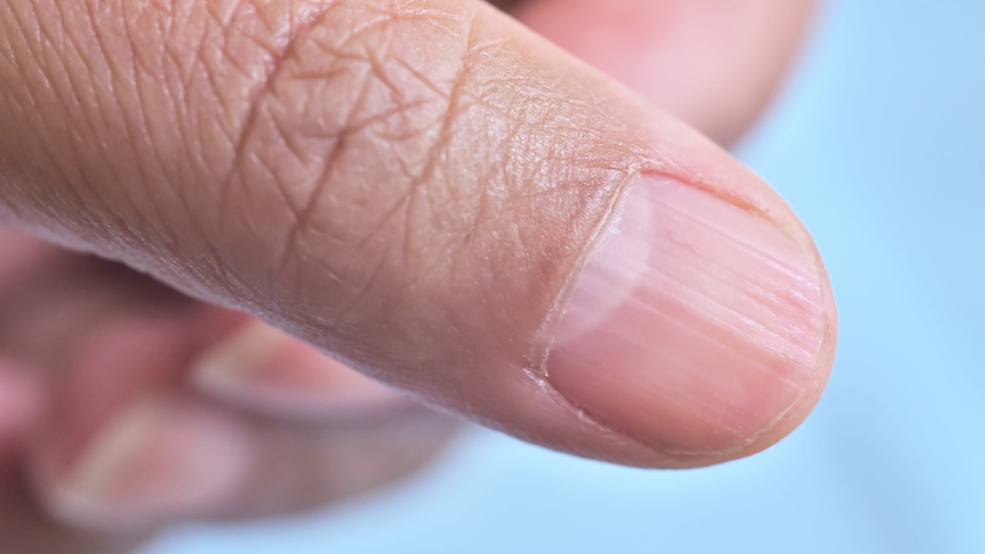 Ce ne ”spun” unghiile cu striații despre  starea de sănătate